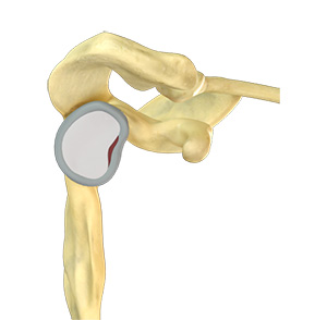 Shoulder Labral Repair